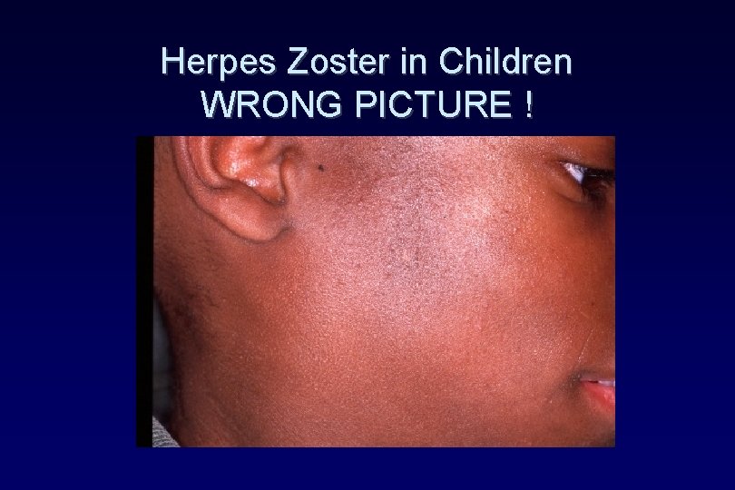 Herpes Zoster in Children WRONG PICTURE ! Herpes Zoster in Children WRONG PICTURE !