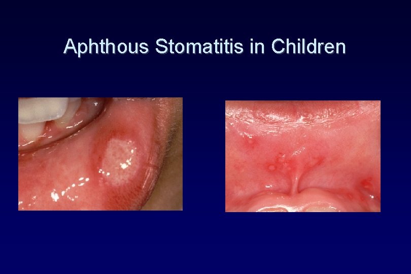 Aphthous Stomatitis in Children Aphthous Stomatitis in Children