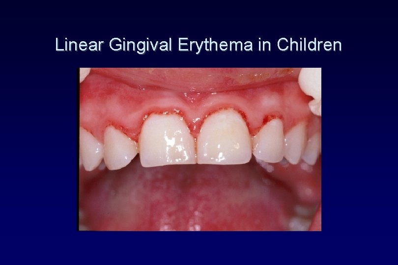 Linear Gingival Erythema in Children Linear Gingival Erythema in Children