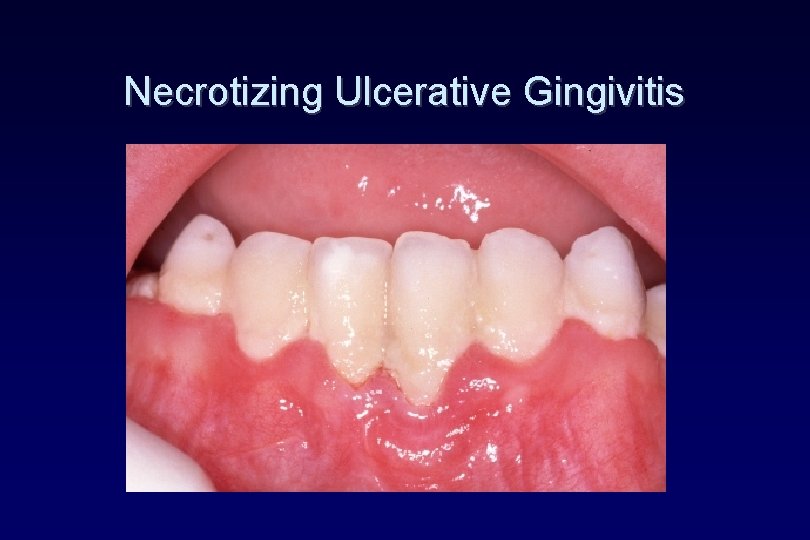 Necrotizing Ulcerative Gingivitis Necrotizing Ulcerative Gingivitis