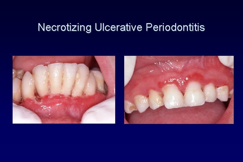 Necrotizing Ulcerative Periodontitis Necrotizing Ulcerative Periodontitis