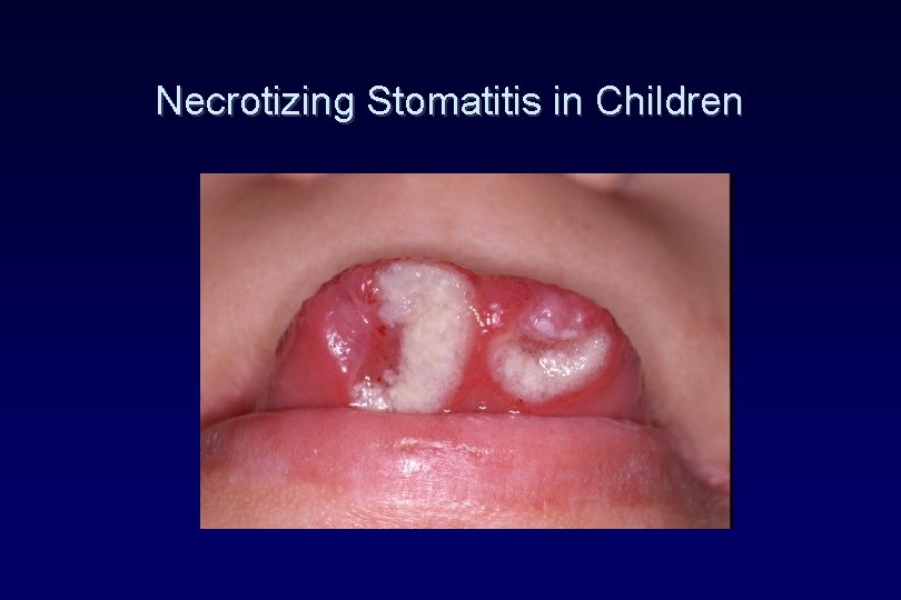 Necrotizing Stomatitis in Children Necrotizing Stomatitis in Children