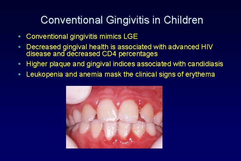 Conventional Gingivitis in Children • Conventional gingivitis mimics LGE • Decreased gingival health is Conventional Gingivitis in Children • Conventional gingivitis mimics LGE • Decreased gingival health is