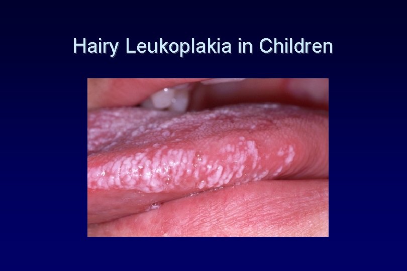 Hairy Leukoplakia in Children Hairy Leukoplakia in Children