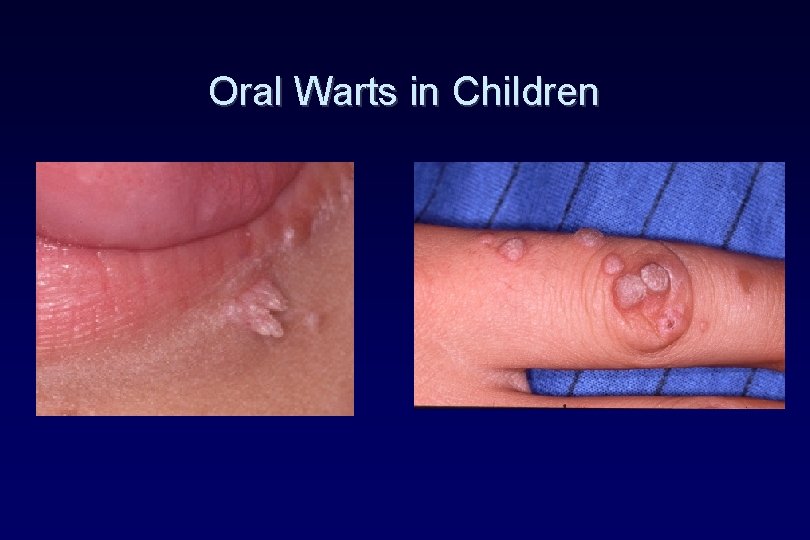 Oral Warts in Children Oral Warts in Children