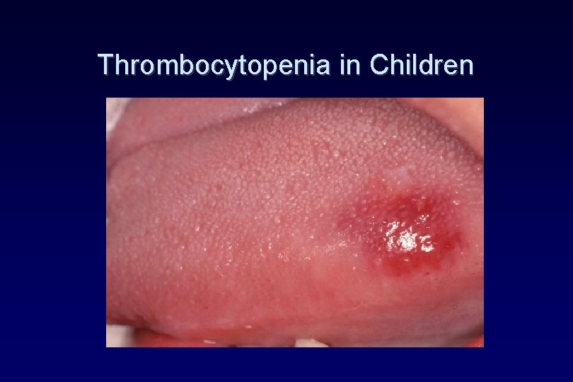 Thrombocytopenia in Children Thrombocytopenia in Children