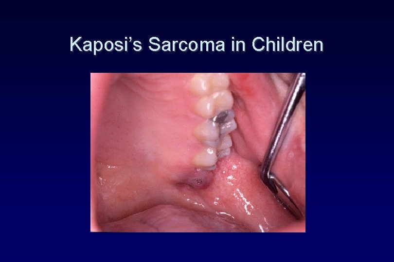 Kaposi’s Sarcoma in Children Kaposi’s Sarcoma in Children