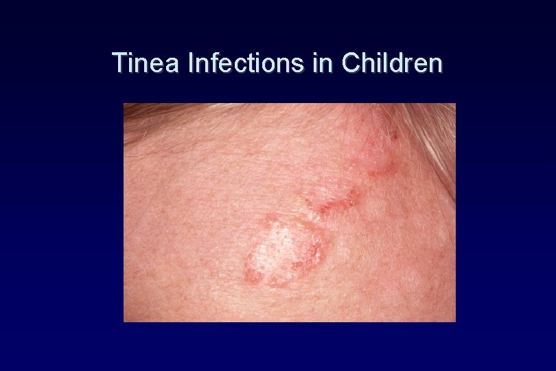 Tinea Infections in Children Tinea Infections in Children