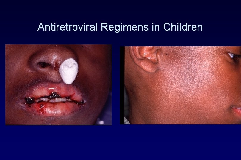 Antiretroviral Regimens in Children Antiretroviral Regimens in Children