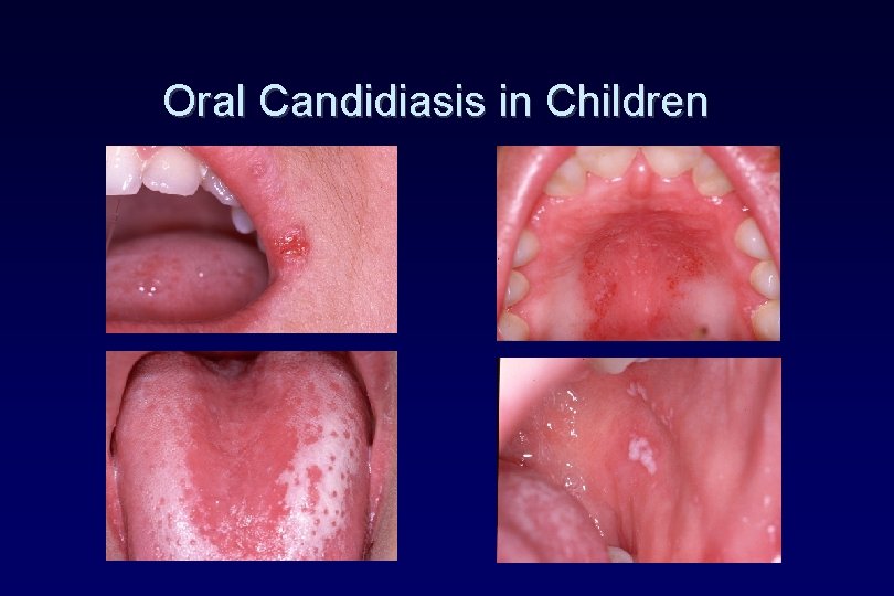 Oral Candidiasis in Children Oral Candidiasis in Children