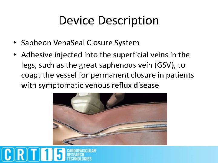 Device Description • Sapheon Vena. Seal Closure System • Adhesive injected into the superficial