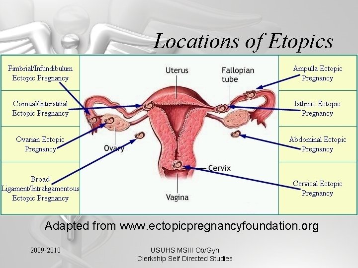 Locations of Etopics Adapted from www. ectopicpregnancyfoundation. org 2009 -2010 USUHS MSIII Ob/Gyn Clerkship