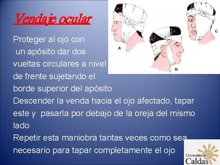 Vendaje ocular Proteger al ojo con un apósito dar dos vueltas circulares a nivel