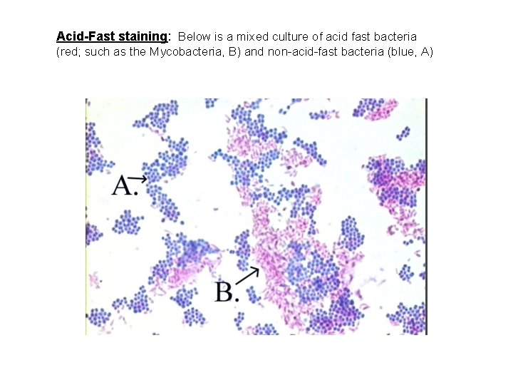 Acid-Fast staining: Below is a mixed culture of acid fast bacteria (red; such as