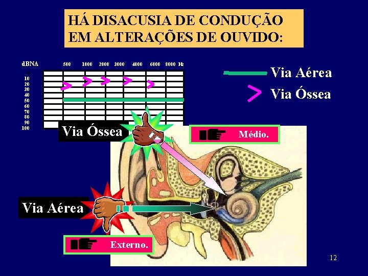 HÁ DISACUSIA DE CONDUÇÃO EM ALTERAÇÕES DE OUVIDO: d. BNA 0 10 20 30