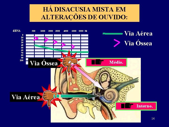 HÁ DISACUSIA MISTA EM ALTERAÇÕES DE OUVIDO: d. BNA 0 10 20 30 40