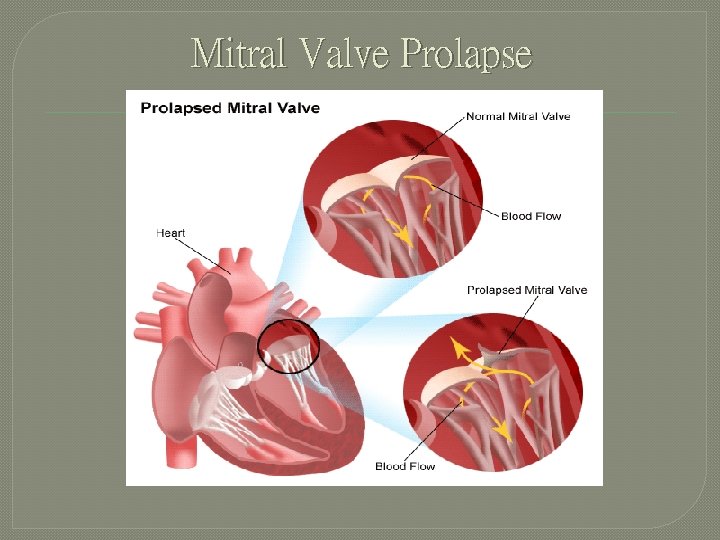 Mitral Valve Prolapse 