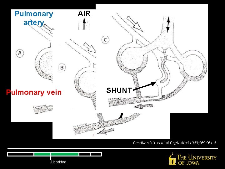 Pulmonary artery Pulmonary vein AIR SHUNT Bendixen HH. et al. N Engl J Med Pulmonary artery Pulmonary vein AIR SHUNT Bendixen HH. et al. N Engl J Med