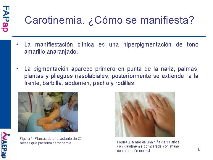 Carotinemia. ¿Cómo se manifiesta? • La manifiestación clínica es una hiperpigmentación de tono amarillo