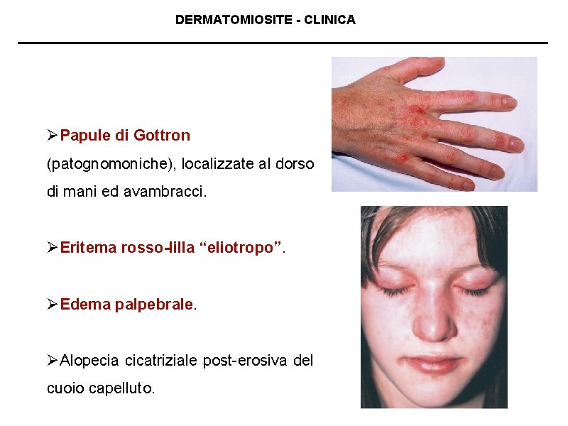 DERMATOMIOSITE - CLINICA ØPapule di Gottron (patognomoniche), localizzate al dorso di mani ed avambracci.