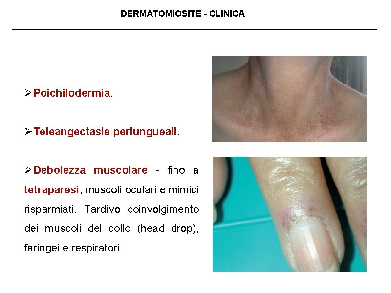 DERMATOMIOSITE - CLINICA ØPoichilodermia. ØTeleangectasie periungueali. ØDebolezza muscolare - fino a tetraparesi, muscoli oculari