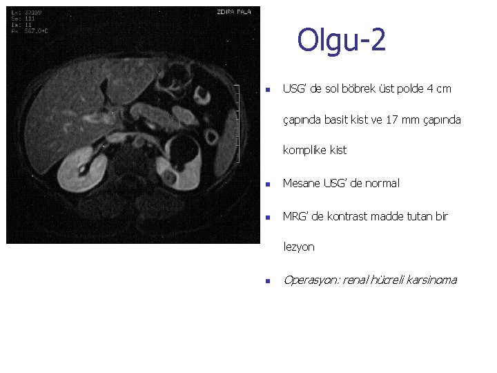 Olgu-2 n USG’ de sol böbrek üst polde 4 cm çapında basit kist ve