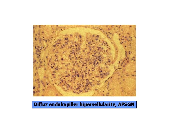 Diffuz endokapiller hipersellularite, APSGN 