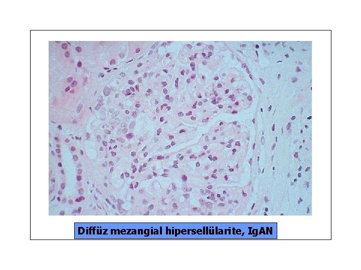 Diffüz mezangial hipersellülarite, Ig. AN 
