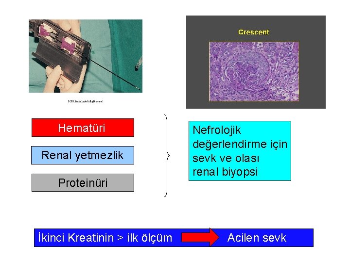 Hematüri Renal yetmezlik Proteinüri İkinci Kreatinin > ilk ölçüm Nefrolojik değerlendirme için sevk ve