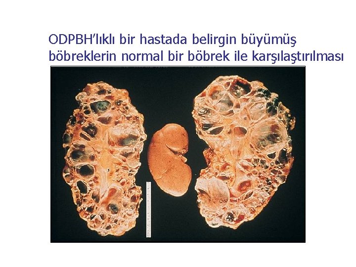 ODPBH’lıklı bir hastada belirgin büyümüş böbreklerin normal bir böbrek ile karşılaştırılması 