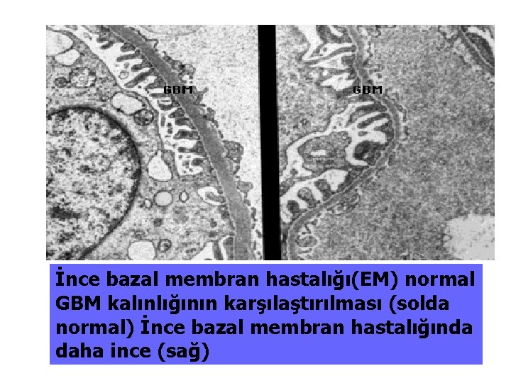 İnce bazal membran hastalığı(EM) normal GBM kalınlığının karşılaştırılması (solda normal) İnce bazal membran hastalığında