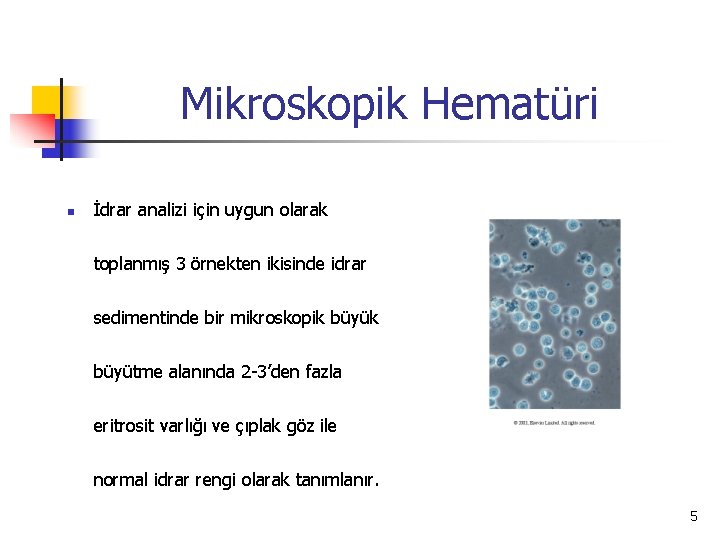 Mikroskopik Hematüri n İdrar analizi için uygun olarak toplanmış 3 örnekten ikisinde idrar sedimentinde