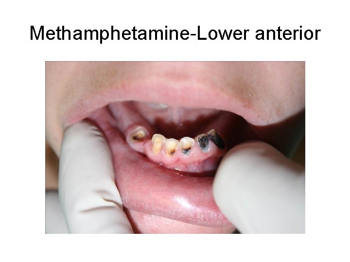 Methamphetamine-Lower anterior 