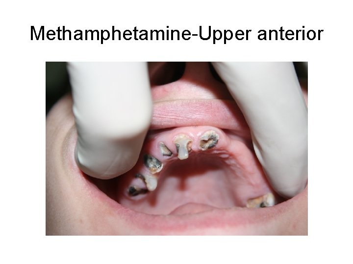 Methamphetamine-Upper anterior 