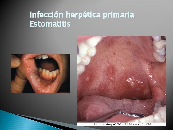 Infección herpética primaria Estomatitis 