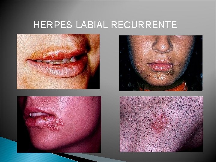 HERPES LABIAL RECURRENTE 