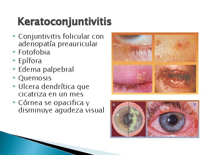 Keratoconjuntivitis Conjuntivitis folicular con adenopatía preauricular Fotofobia Epífora Edema palpebral Quemosis Ulcera dendrítica que