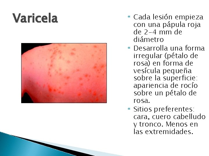 Varicela Cada lesión empieza con una pápula roja de 2 -4 mm de diámetro