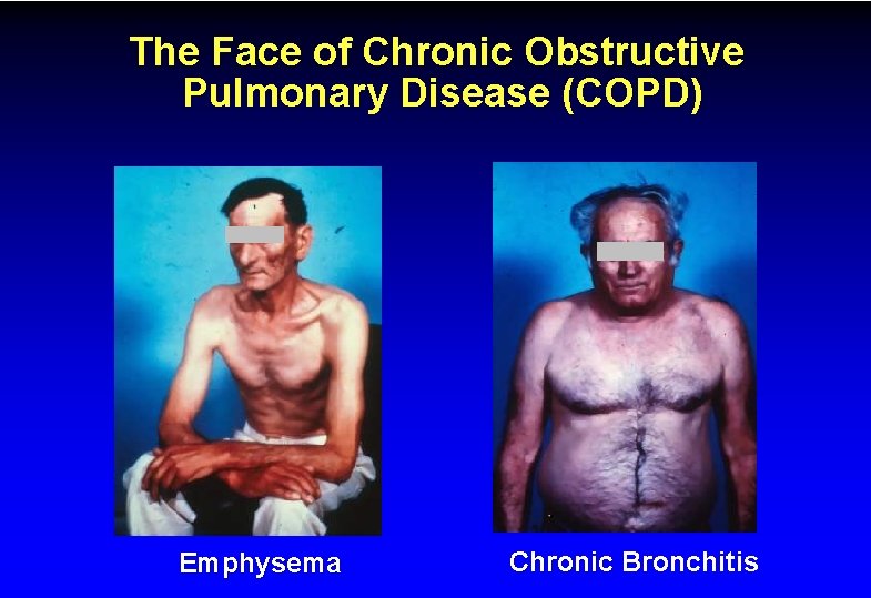 The Face of Chronic Obstructive Pulmonary Disease (COPD) Emphysema Chronic Bronchitis 