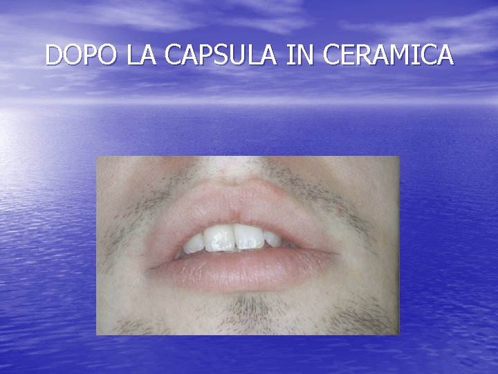 DOPO LA CAPSULA IN CERAMICA 