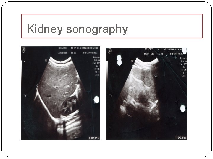  Kidney sonography 