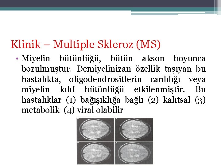 Klinik – Multiple Skleroz (MS) • Miyelin bütünlüğü, bütün akson boyunca bozulmuştur. Demiyelinizan özellik Klinik – Multiple Skleroz (MS) • Miyelin bütünlüğü, bütün akson boyunca bozulmuştur. Demiyelinizan özellik