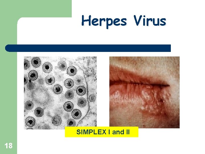 Herpes Virus SIMPLEX I and II 18 