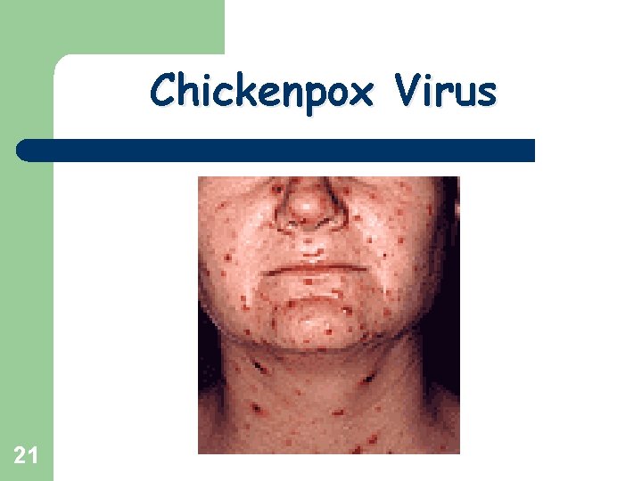 Chickenpox Virus 21 