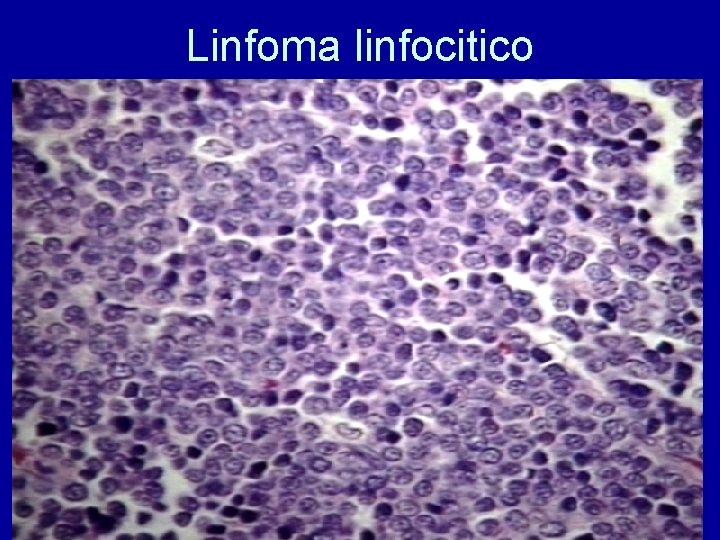 Linfoma linfocitico 