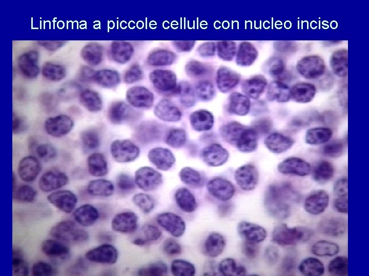 Linfoma a piccole cellule con nucleo inciso 