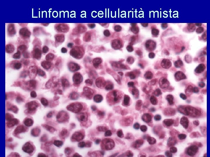 Linfoma a cellularità mista 