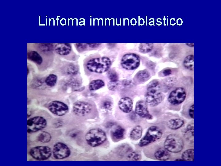 Linfoma immunoblastico 