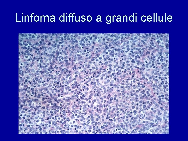 Linfoma diffuso a grandi cellule 