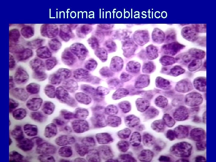 Linfoma linfoblastico 